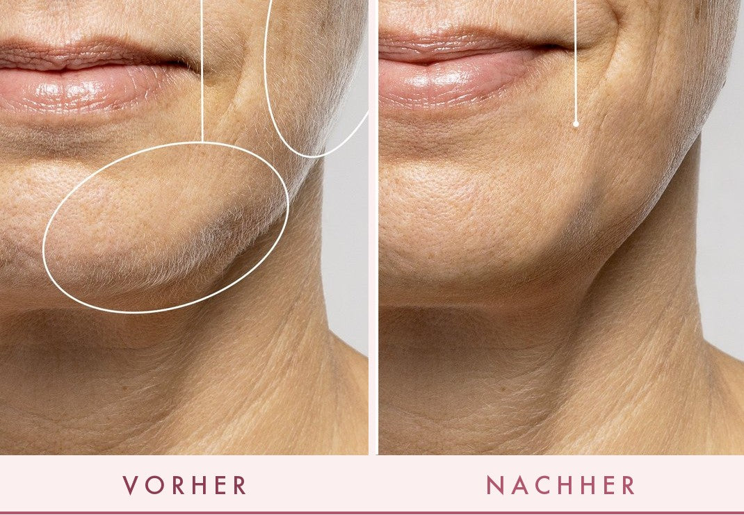 Vorher und nachher: glattere, strahlendere Haut mit FLERMIX